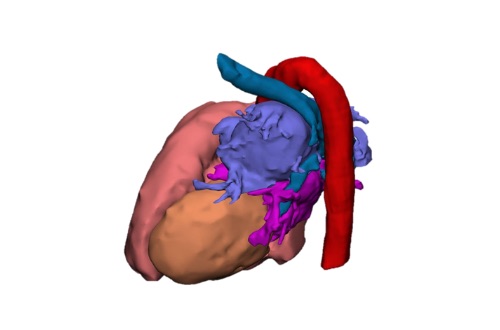Rendering 3D di cardiochirurgia pediatrica con elementi in stampa 3D