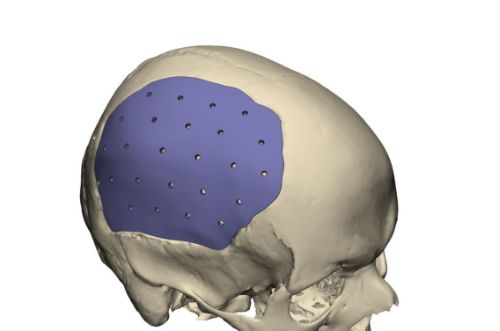 Rendering 3D di un'operazione di neurochirurgia con protesi prodotta con la stampa 3D